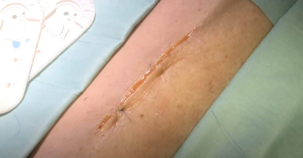 How To Suture Human Skin