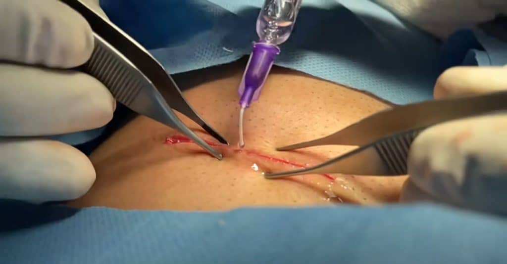 Suture alternative (aucun kit de suture requis)