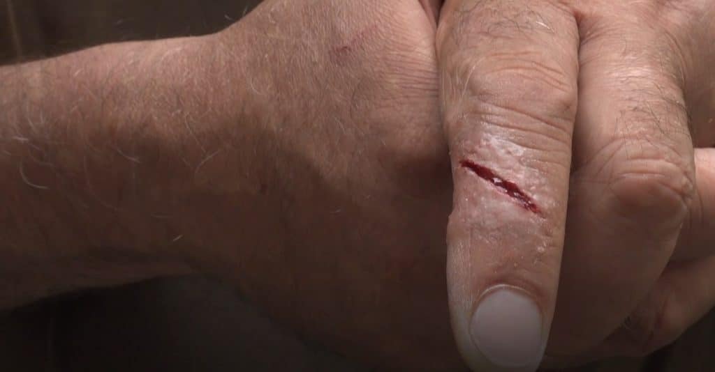 Purpose Of Using Butterfly Bandage
